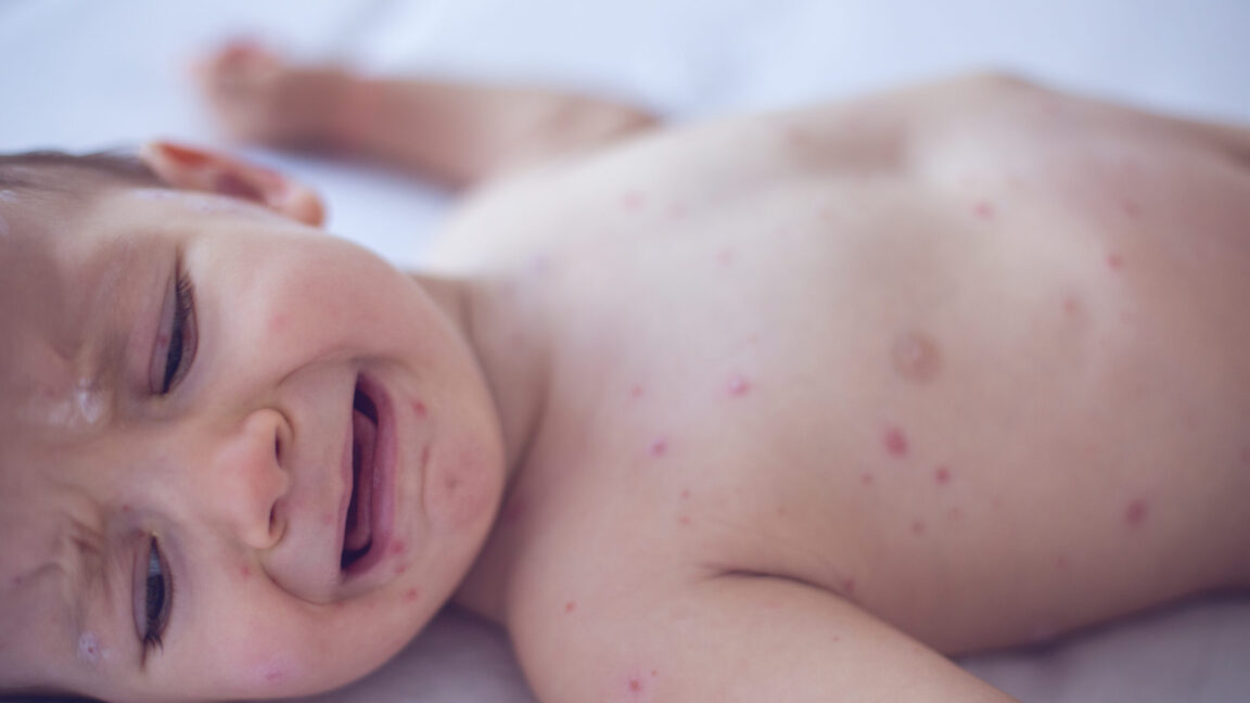 Coroner Confirms Measles Killed Six-Week-Old Baby in Pennsylvania